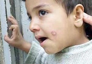 این زخم یک سال بر بدن شما می ماند