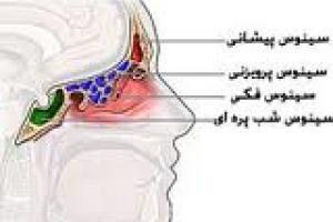 علایم بیماری سینوزیت چیست
