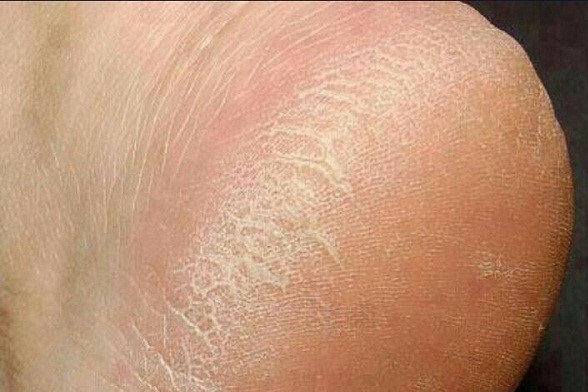 بروز عارضه ای موسوم به &laquo;خارش زمستانی&raquo;/ ارتباط مستقیم تیروئید و خشکی پوست پا