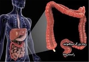 انسداد روده چطور رخ می‌دهد؟