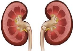 سنگ کلیه چیست و چه کسانی به آن مبتلا می شوند؟