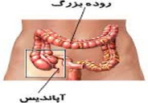 نشانه های آپاندیسیت