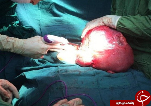 خارج کردن توده ای بزرگ از شکم بیمار ۳۲ ساله در گرگان + تصاویر