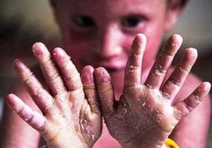 ارسال ۴۷۳۷ بسته پانسمان رایگان برای بیماران پروانه‌ای