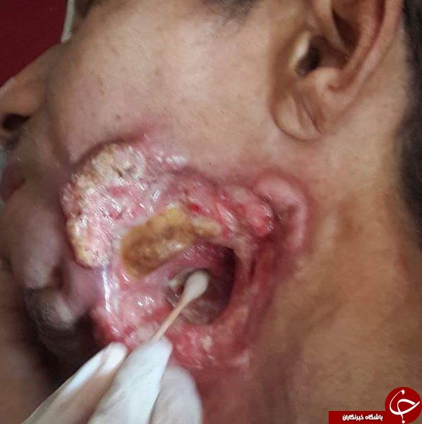 سرطان نادر و عجیب مرد تایلندی + تصاویر/ 18+
