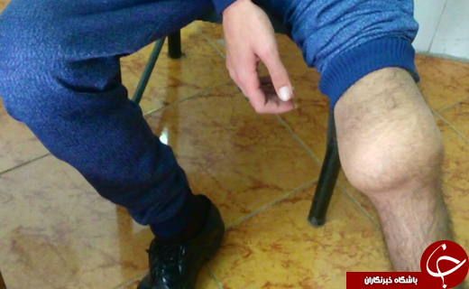 نگاهی به شرایط خاص حدود 200 بیمار هموفیلی گلستان