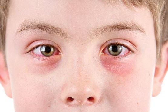 چگونه از پف کردگی چشم خلاص شویم؟