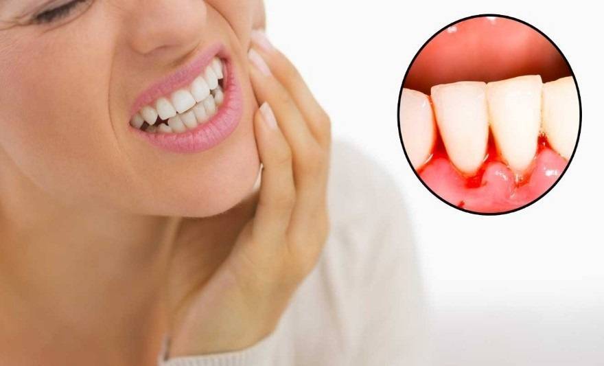 خونریزی لثه نشانه چیست؟