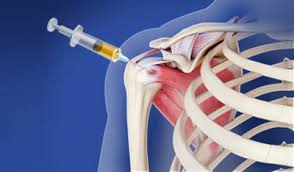 یخ زدگی شانه چیست و چگونه درمان می شود؟