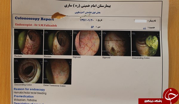خارج کردن باند استریل از بدن  یک زن 56 ساله!+ تصاویر