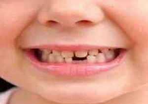 داشتن دندان دائمی سالم در گرو دندان&zwnj;های منظم شیری/ لزوم حفاظت از دندان&zwnj;های شیری در کودکان