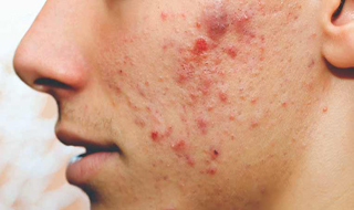 ترفند&zwnj;های ساده و موثر برای جلوگیری از تحریک آکنه ها+اینفوگرافیک