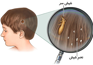 کمبود مربی بهداشت عامل اصلی شیوع شپش در دانش‌آموزان شیراز/ درمان ۵ هزار دانش‌آموز از ابتلا به شپش
