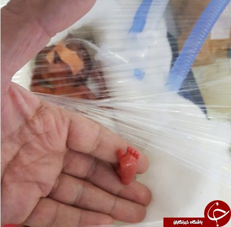 ماجرای نجات کم وزن ترین نوزاد جهان از مرگ+تصاویر