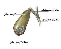 جنیدی// عمل جراحی کیسه صفرا قدمتی 150 ساله دارد.