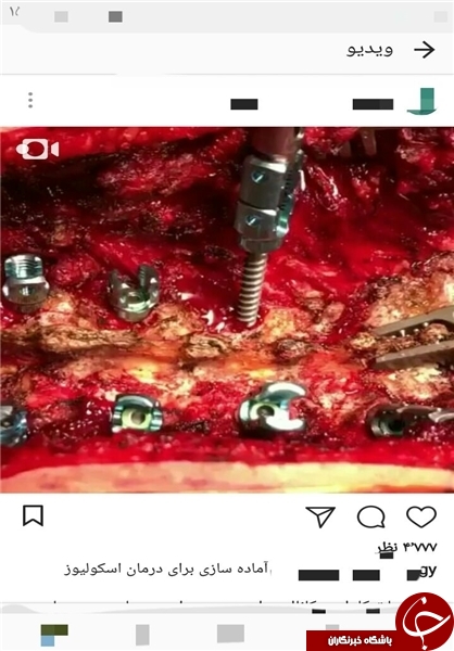 پخش زنده جراحی در اینستاگرام/ جذب مشتری با نمایش قلب و مغز شکافته+ تصاویر