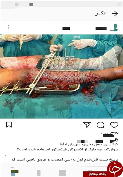 پخش زنده جراحی در اینستاگرام/ جذب مشتری با نمایش قلب و مغز شکافته+ تصاویر