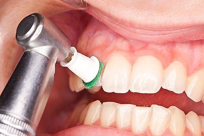 آیا جرم&zwnj;گیری دندان کار درستی است؟
