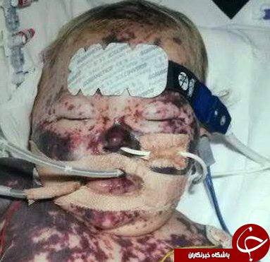 ویدئویی فوق&zwnj;العاده از زندگی دختربچه&zwnj;ای که از مرگ جان سالم به در برده است