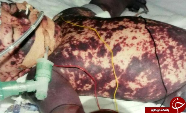 ویدئویی فوق&zwnj;العاده از زندگی دختربچه&zwnj;ای که از مرگ جان سالم به در برده است