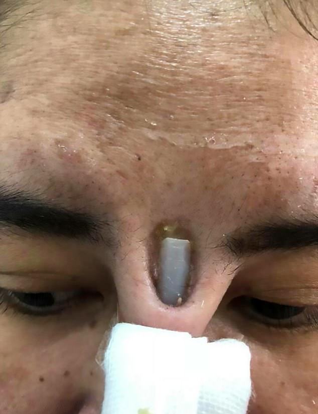 1-حفره&zwnj;ای عمیق درصورت؛ نتیجه انجام عمل جراحی بینی ارزان قیمت دراین زن+ تصاویر2-ترسناک&zwnj;ترین عارضه جانبی جراحی زیبایی بینی درصورت این زن+ تصاویر