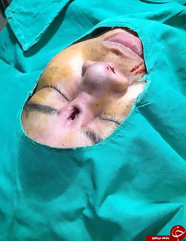 عاقبت وحشتناک جراحی ارزان قیمت بینی در کلینیک غیر استاندارد+تصاویر
