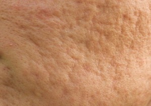 جوان&zwnj;سازی پوست توسط افراد غیر متخصص چه خطراتی دارد؟
