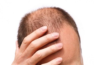 با طاسی خداحافظی کنید