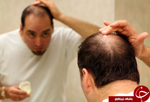 درمان ریزش مو و کچلی با سیب&zwnj;زمینی سرخ&zwnj;شده