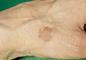 5 نکته‌ای که باید خانم‌ها در مورد لک پوستی بدانند