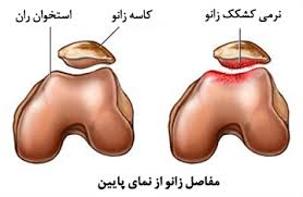خبرنگار: جنیدیعارضه نرمی تشکک چیست؟