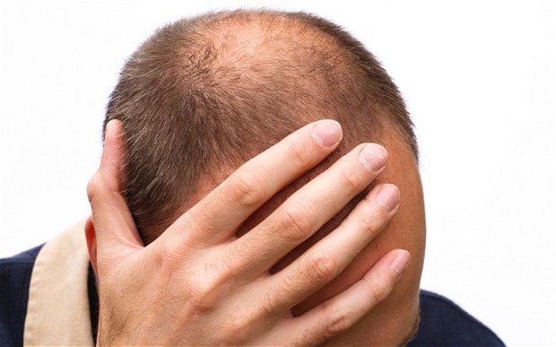 مهم ترین و شایع ترین دلایل ریزش موها