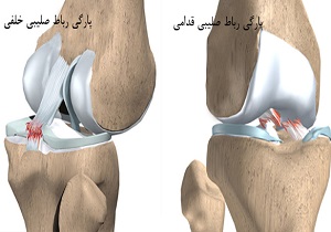 شایع ترین آسیب رباطی زانو چیست؟