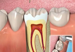 علت درد دندان عصب کشی شده بعد از چند سال چیست؟