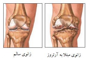چگونه از ابتلا به آرتروز زانو پیشگیری کنیم؟