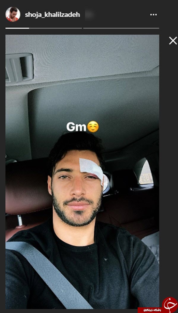 رونمایی از صورت مدافع پرسپولیس بعد از مصدومیت+عکس