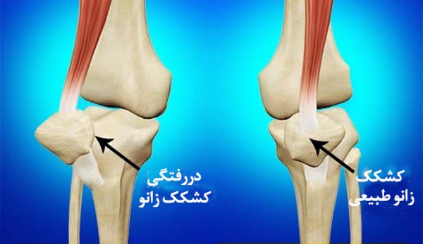 جراحی دررفتگی کشکک زانو به چه کسانی توصیه نمی&zwnj;شود؟