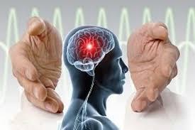 نتایج موفق کارگزاری الکترود عمقی مغز (DBS) در شیراز