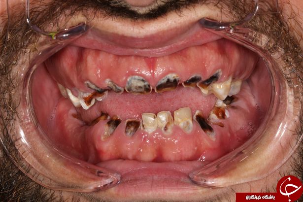 مردی که تمام دندان هایش را پای یک اعتیاد عجیب از دست داد+تصاویر