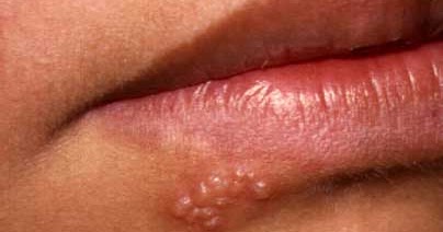 دلیل تبخال&zwnj;های مکرر چیست؟ +راه&zwnj;های پیشگیری
