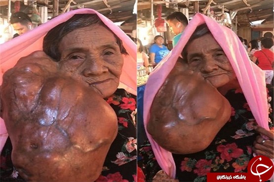 رشد توموری عجیب در صورت یک زن +عکس