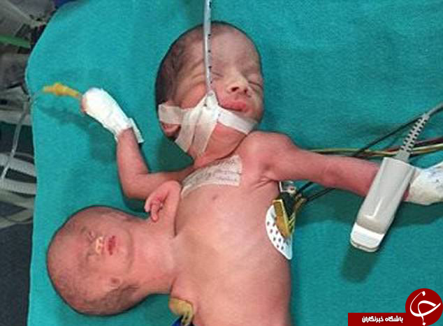 نوزاد دو سر و سه دست جراحی شد+تصاویر 