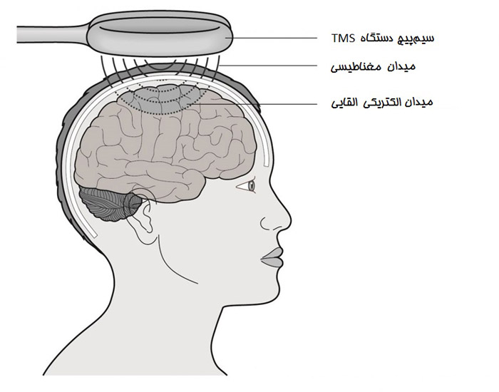 بررسی رابطه افسردگی با نوع ساختار مغز و اتصالات مغزی