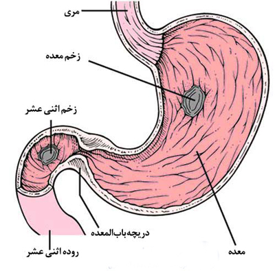 خطر بیماری سوءهاضمه، اگر به موقع درمان نشود