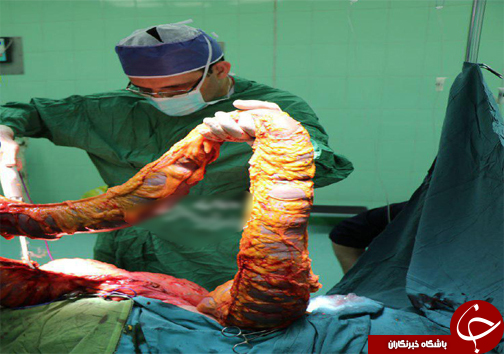 خارج کردن روده 5 کیلوگرمی از شکم + تصاویر