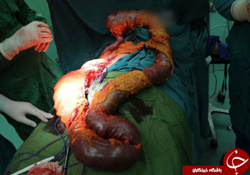 خارج کردن روده 5 کیلوگرمی از شکم + تصاویر