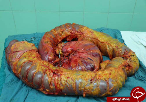 خارج کردن روده 5 کیلوگرمی از شکم + تصاویر