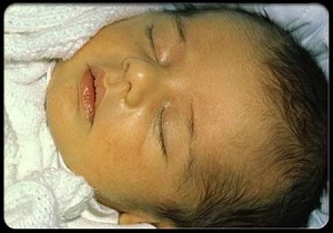 علت زردی کودکان مشخص شد