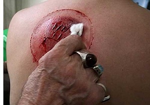 بهترین فصل برای حجامت/ نکاتی درباره زالودرمانی