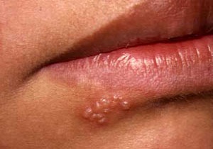 همه آنچه از تبخال نمی‌دانید؟